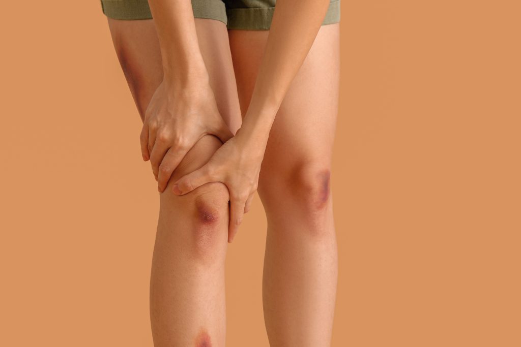 Τα 4 σημάδια που δείχνουν ότι μπορεί να έχετε θρόμβο στο πόδι