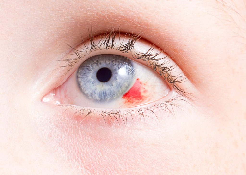 Έχετε σπασμένο αγγείο στο μάτι; Πώς να το αντιμετωπίσετε μόνοι σας στο σπίτι