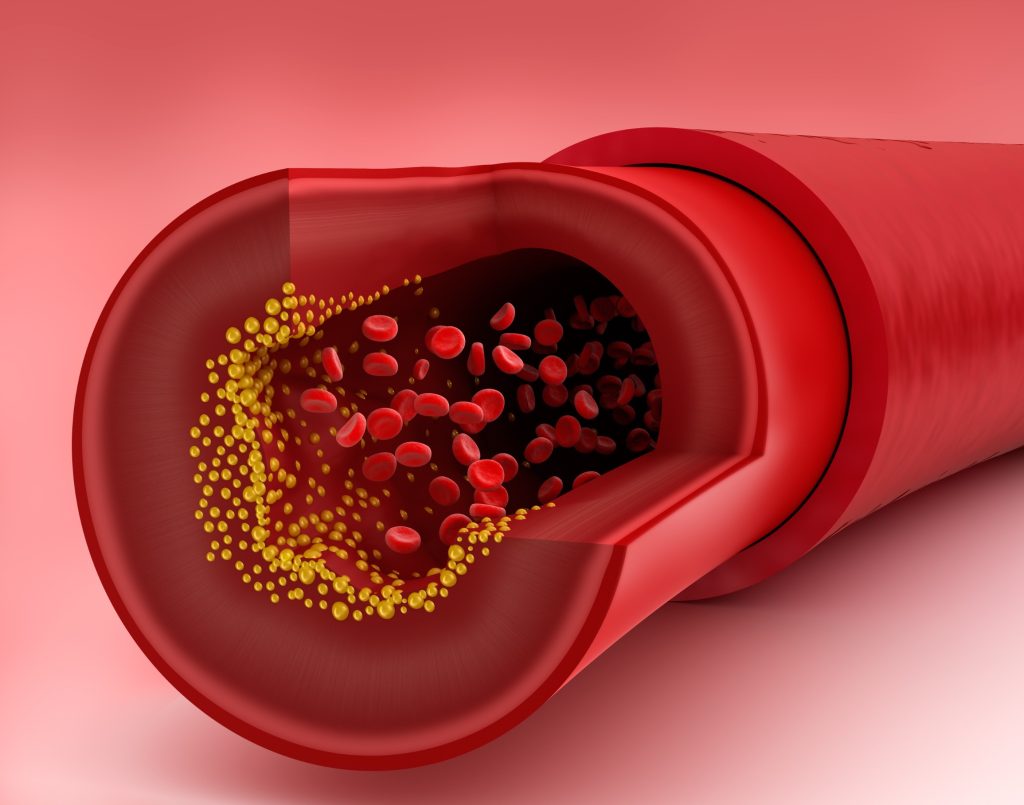Χοληστερόλη: Ο τύπος των λιπιδίων που μπορεί να προκαλέσει καρδιακή προσβολή – Δεν φαίνεται στις εξετάσεις
